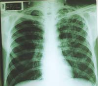Uma inimiga chamada tuberculose